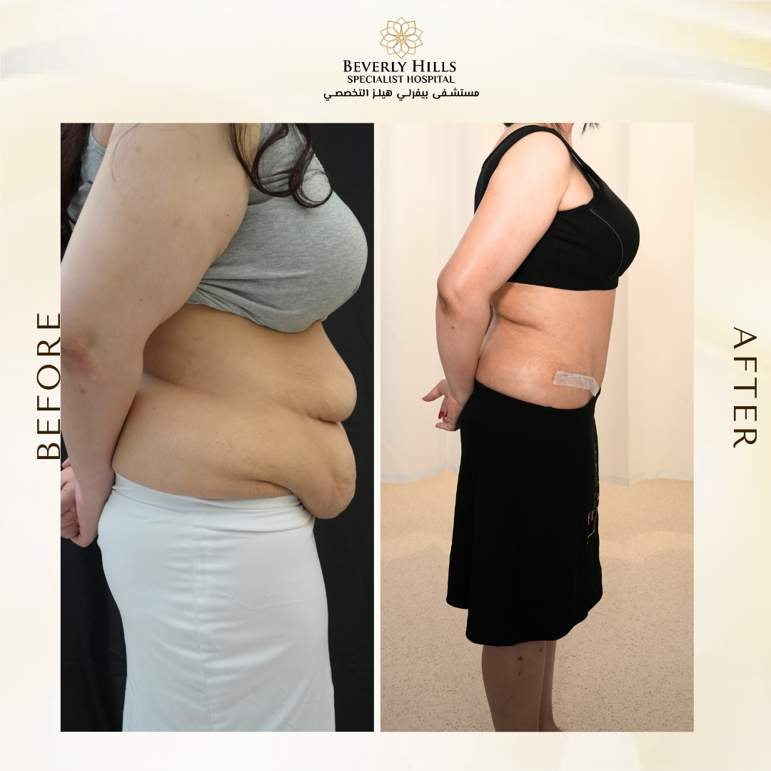 Full Tummy Tuck + 4D Sculpting + Kim Kardashian Technique