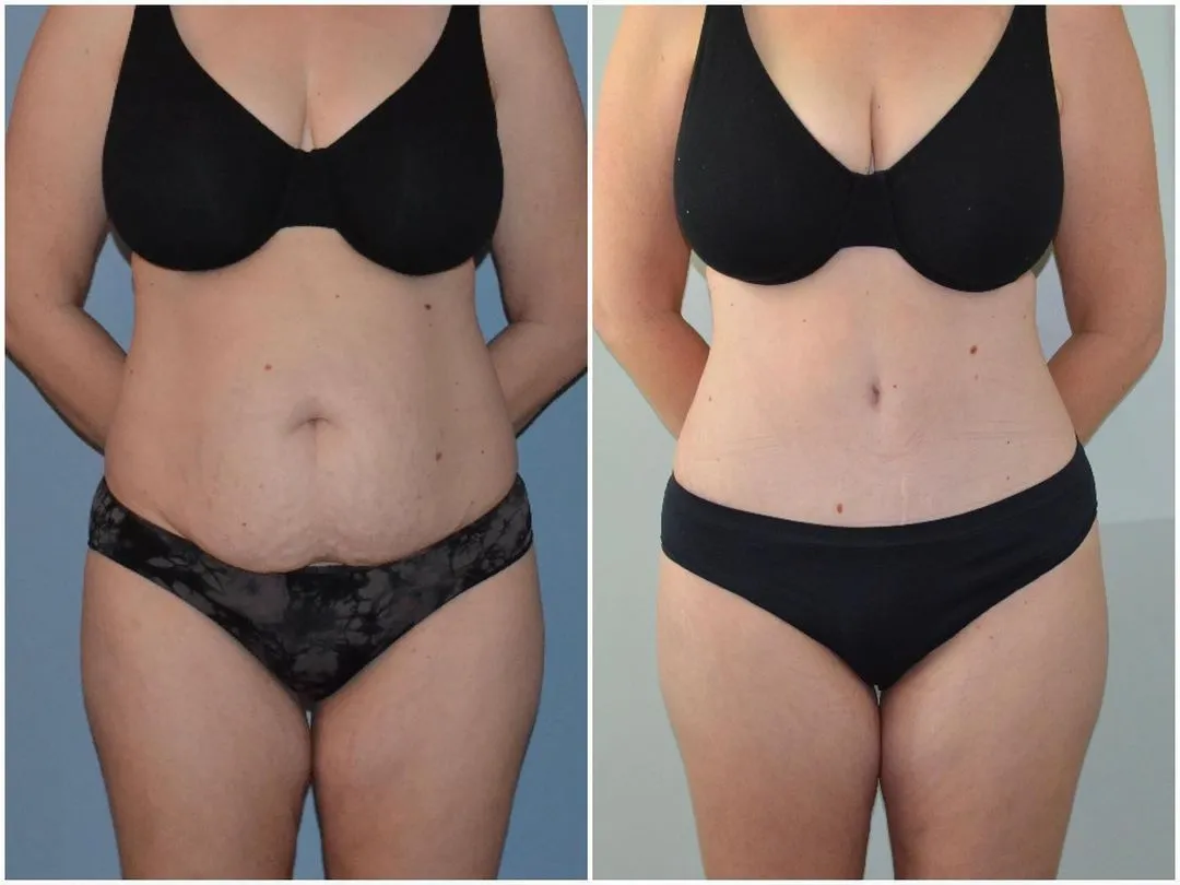 Mini Tummy Tuck