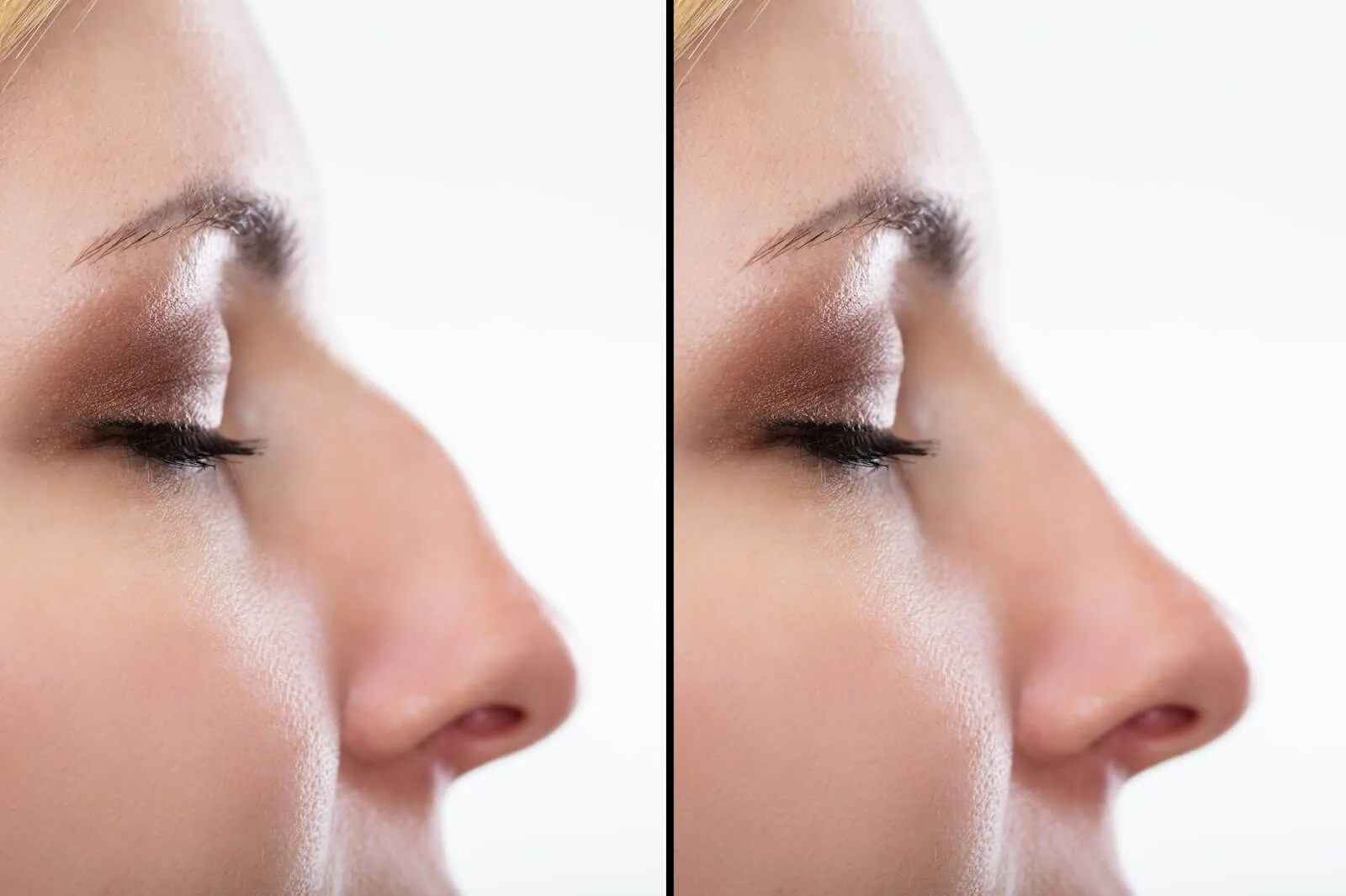 Rhinoplasty