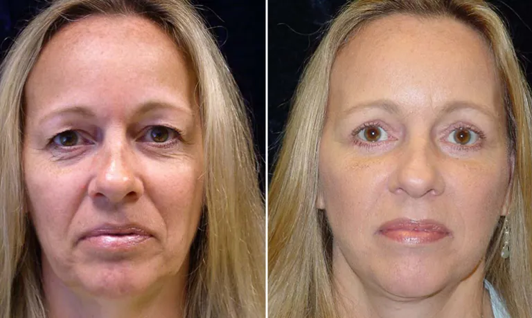 Eye Opening Procedure